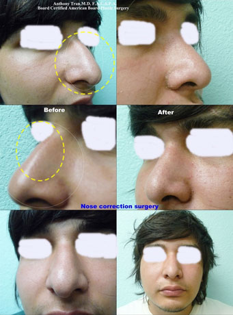 Nose Surgery, Arlington Plastic Surgery