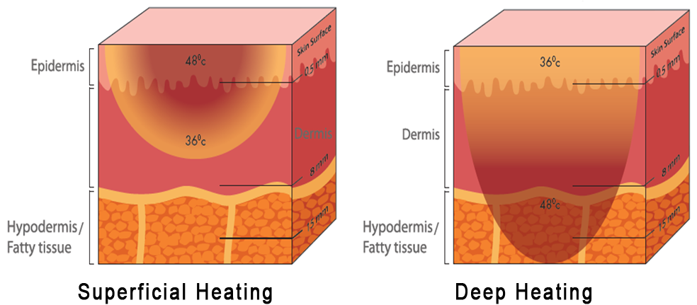 Superficial Heating, Deep Heating