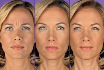 Botox, Arlington Plastic Surgery