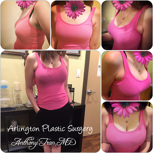 Breast Augmentation in Arlington, TX