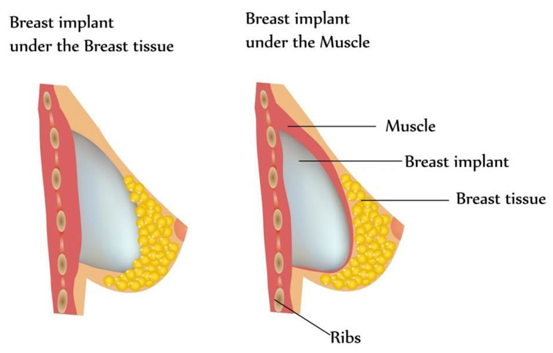 Breast Implant, Arlington Plastic Surgery