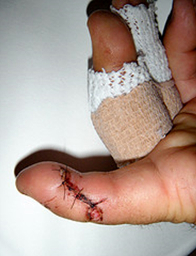 finger surgery