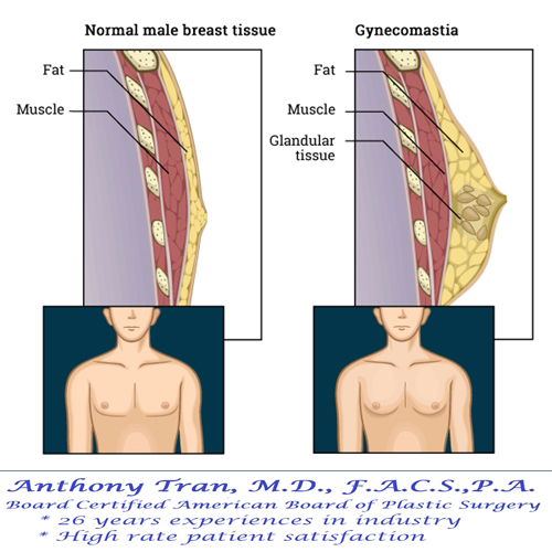 Male Breast Reduction in Arlington, TX