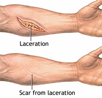 Hand Scar, Arlington Plastic Surgery