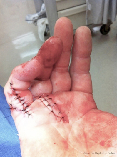 hand surgery
