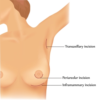 Breast Augmentation, Arlington Plastic Surgery
