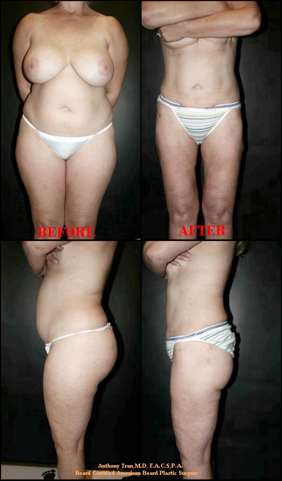 liposuction1