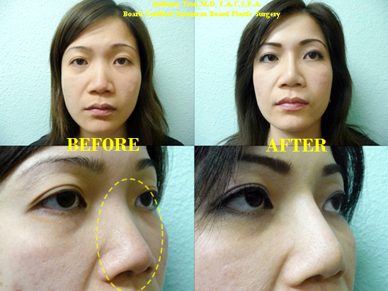 Nose Surgery vietnamese