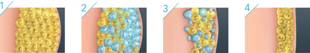 Coolsculpting procedure visual before and after