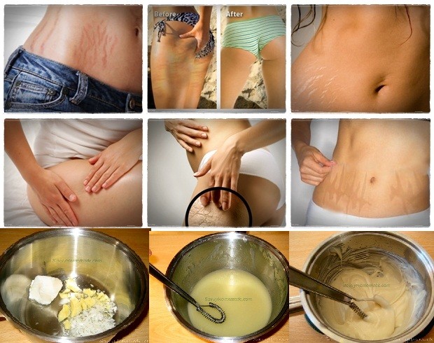 Homemade Creams for Old Stretch Marks Kansas