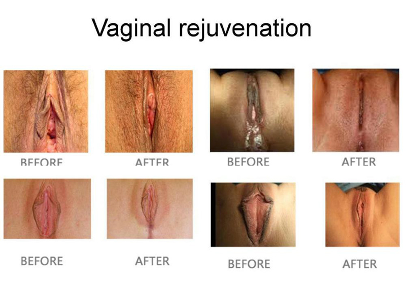 Vaginal Rejuvenation Treatments Near Me Nj