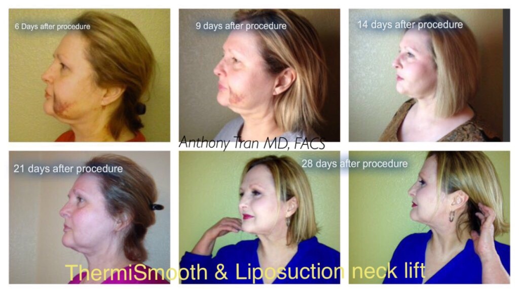ThermiSmooth Patient Before & After Photos