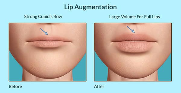 Lip Fillers