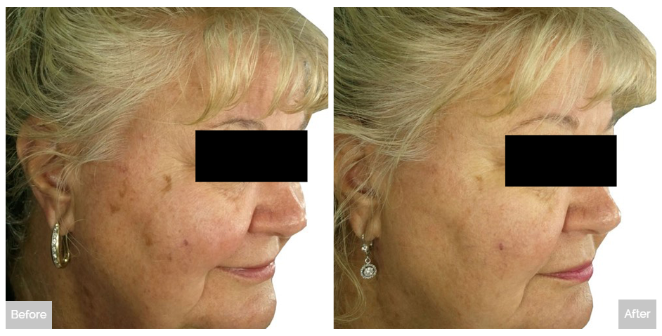 Tribella Before and After