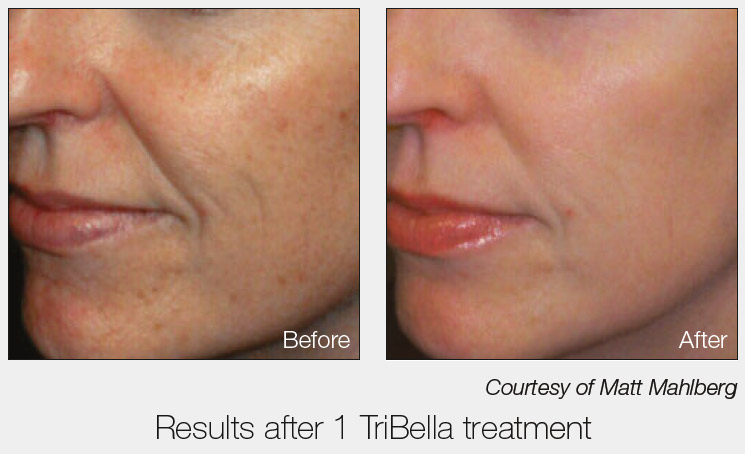 Tribella - Total Facial Therapy